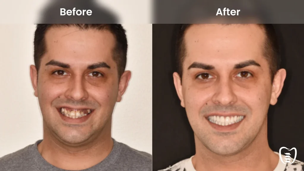 Before and after dental implants at All On Implants Virginia Beach