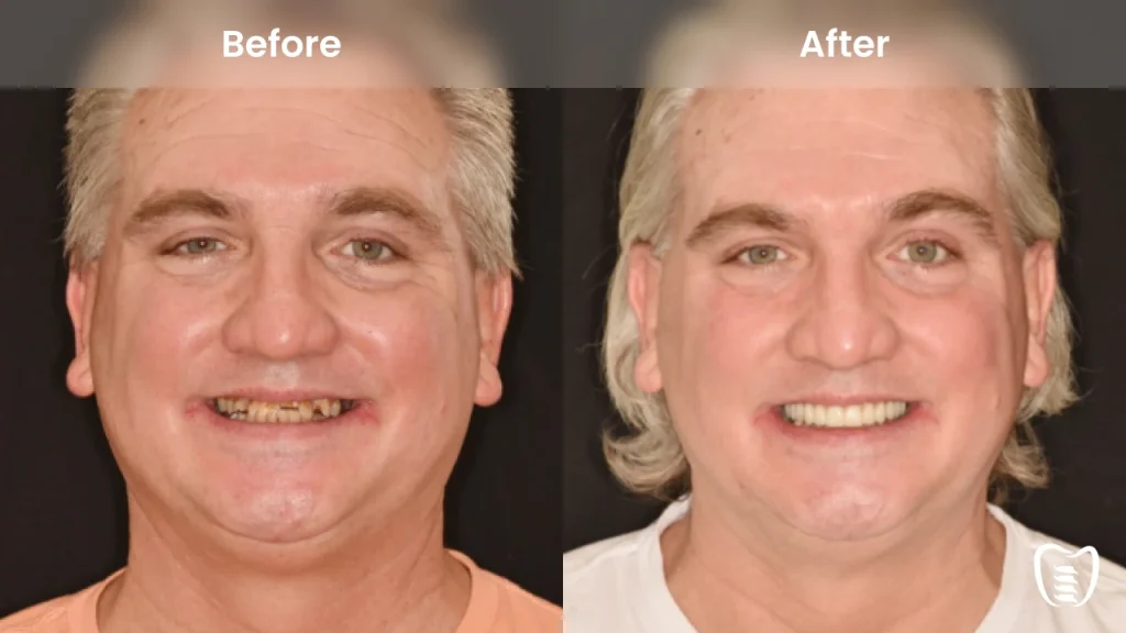 Before and after dental implants at All On Implants Virginia Beach