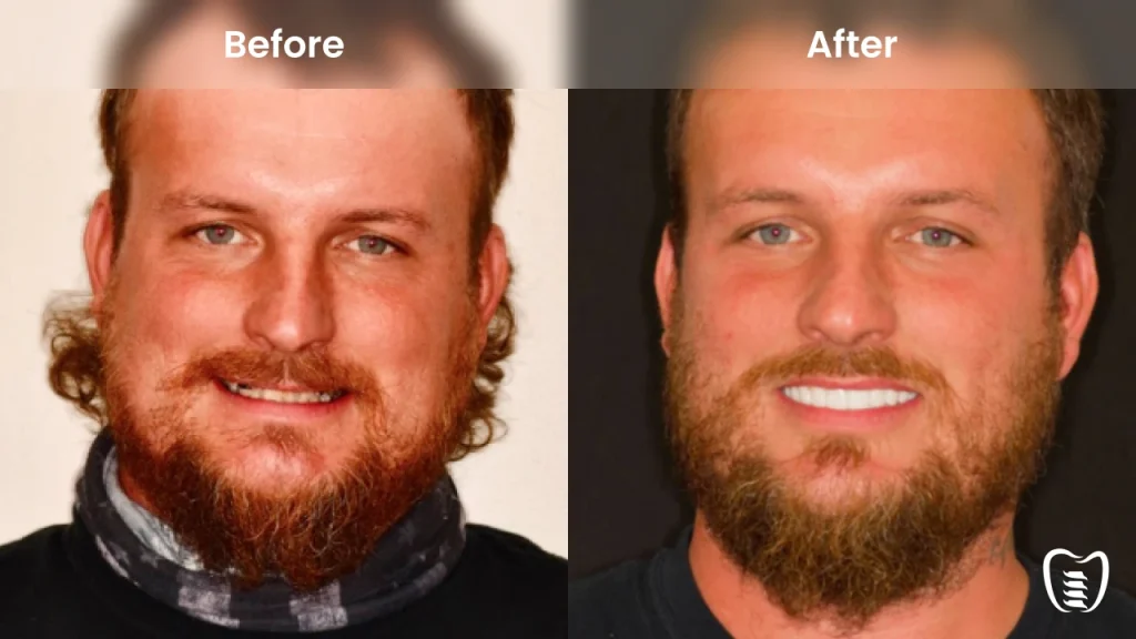 Before and after dental implants at All On Implants Virginia Beach
